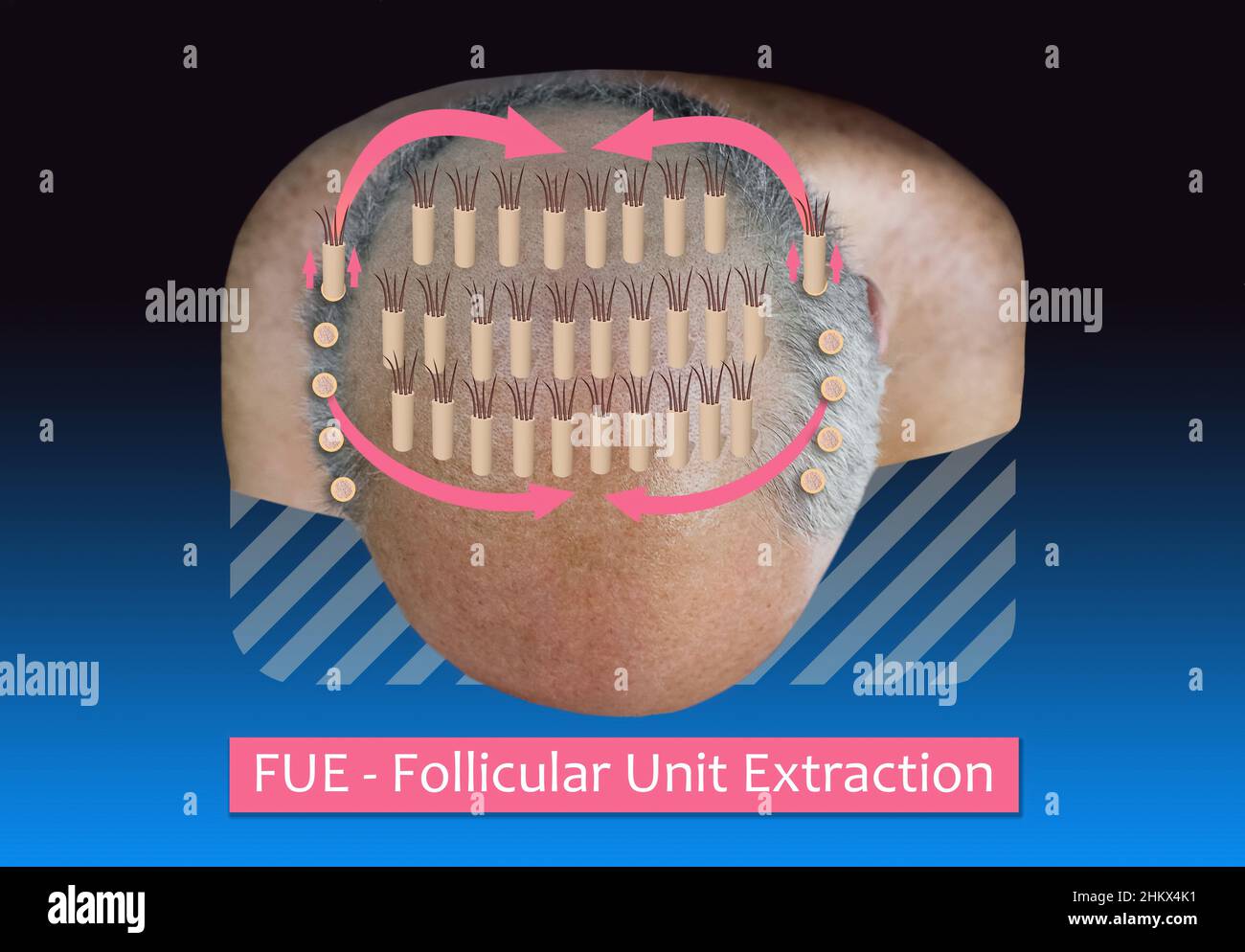 Methods of hair transplantation FUT and FUE fue with transplant as infographic element of illustration. Human alopecia or hair loss problem on adult senior or mature man. Before and after concept Stock Photo