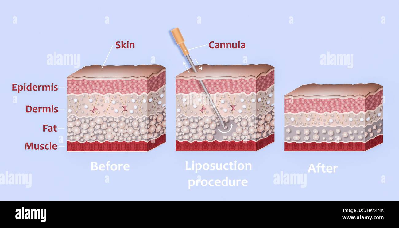 Mechanism of liposuction. Suction-assisted liposuction. Hollow tube or cannula, which is inserted through a small incision in the skin in order to fat suctioned out of the body. 3D illustration Stock Photo