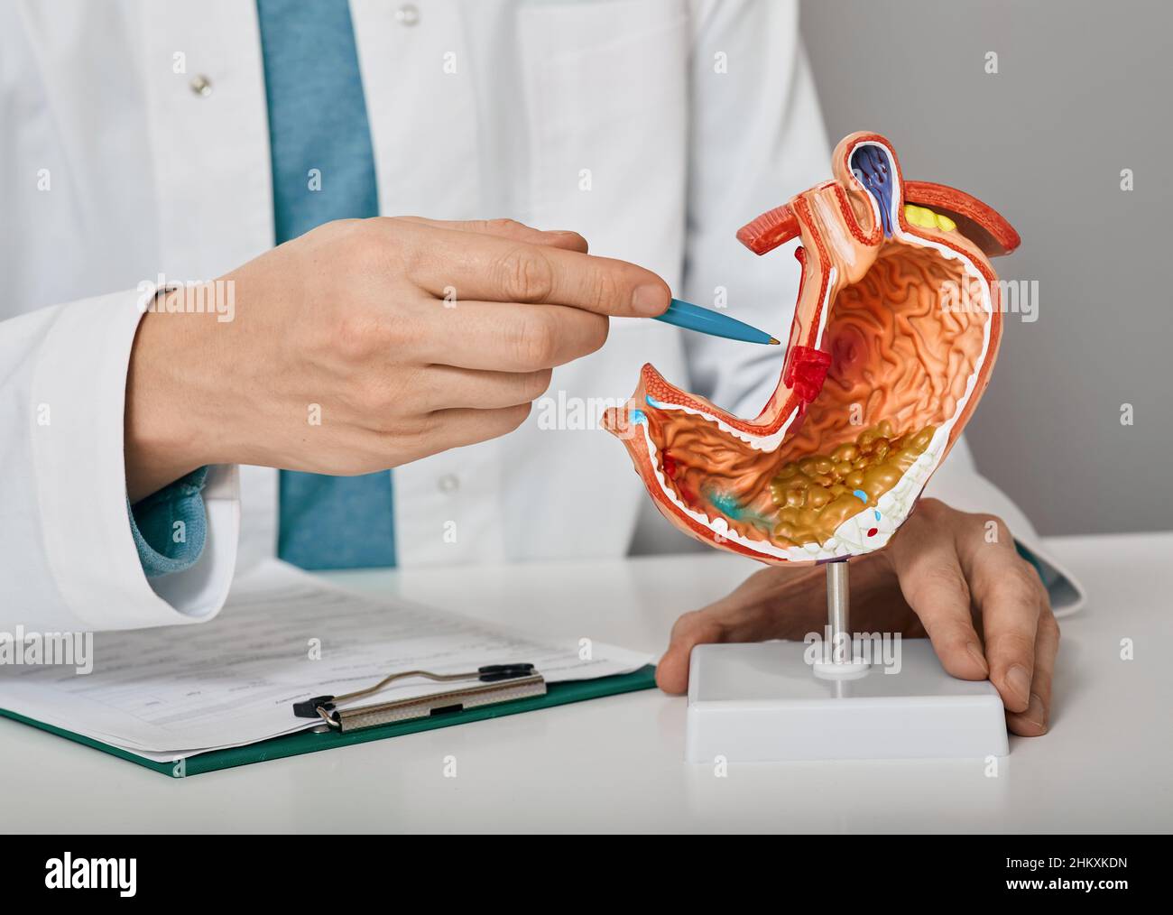 Gastroenterologist consultation, treatment of stomach diseases and ulcers. doctor pointing to gastric ulcer on anatomical model of stomach Stock Photo