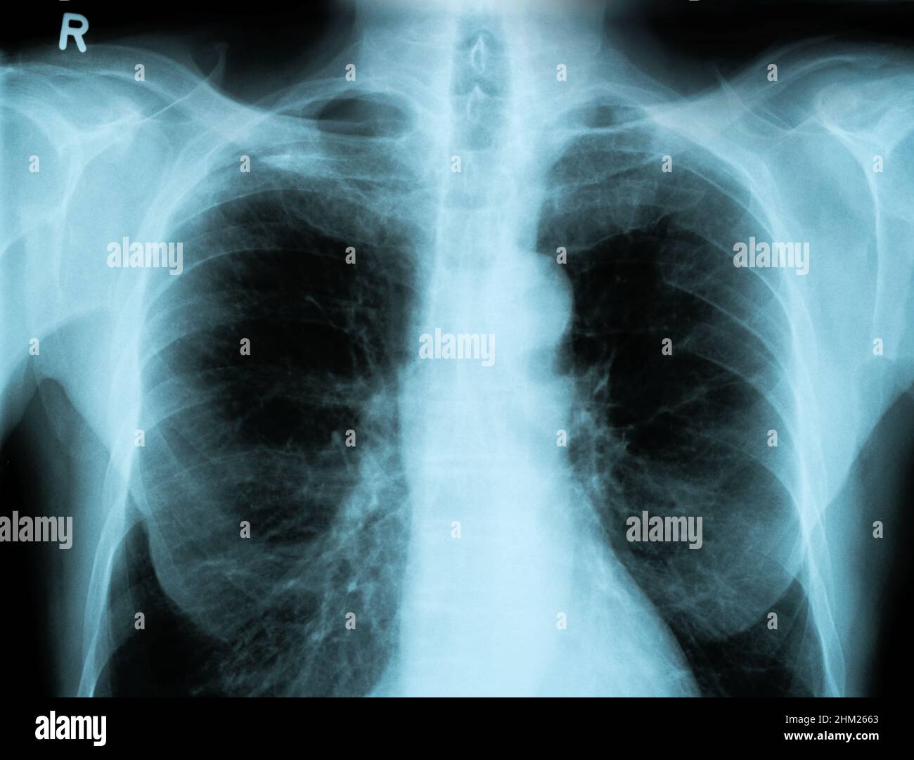 X-Ray Image Of Human Chest Stock Photo