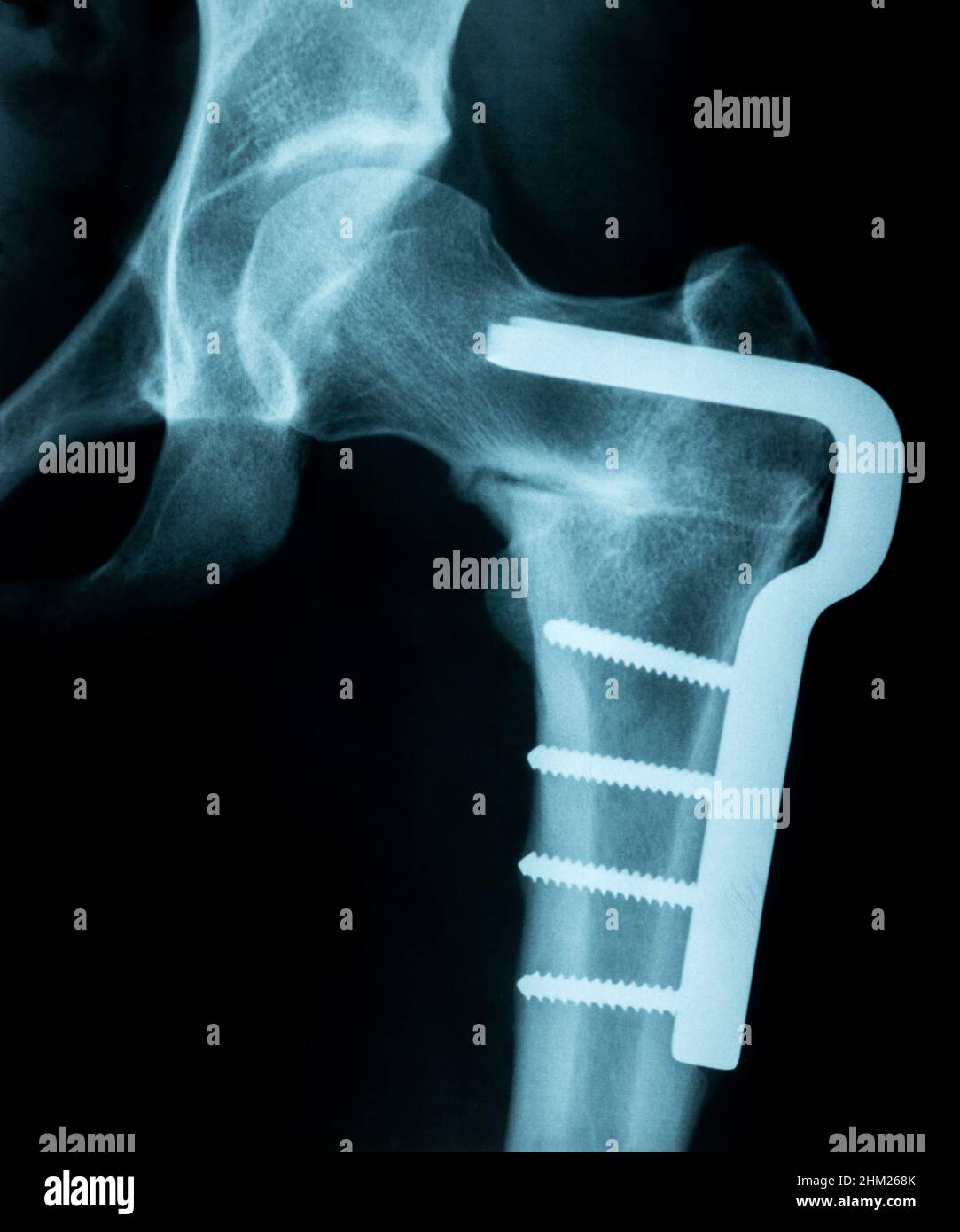 X-Ray Image of a broken pelvis/hip with metal pins holding it together Stock Photo