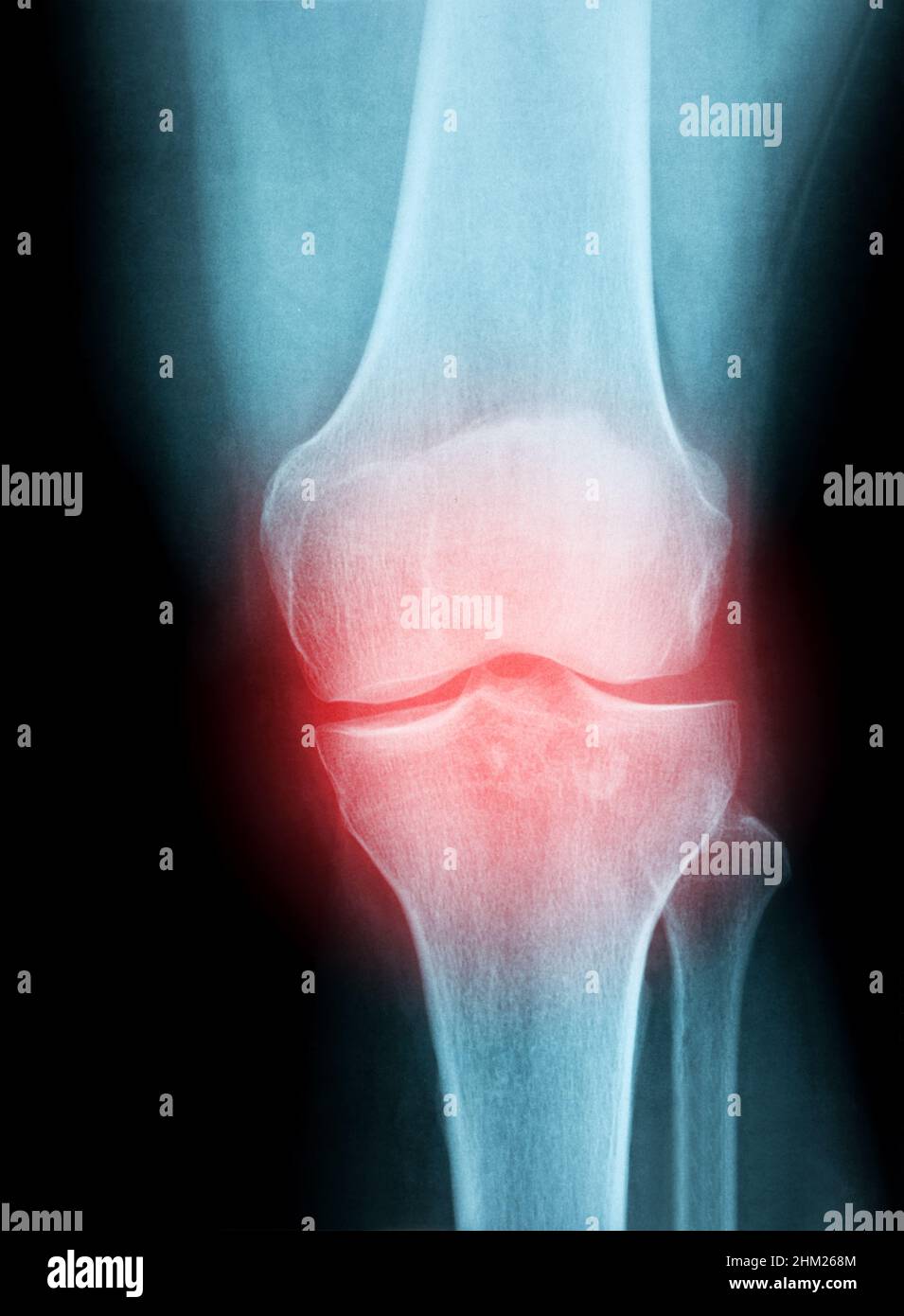 X-Ray Image of a Human knee joint for a medical diagnosis Stock Photo ...