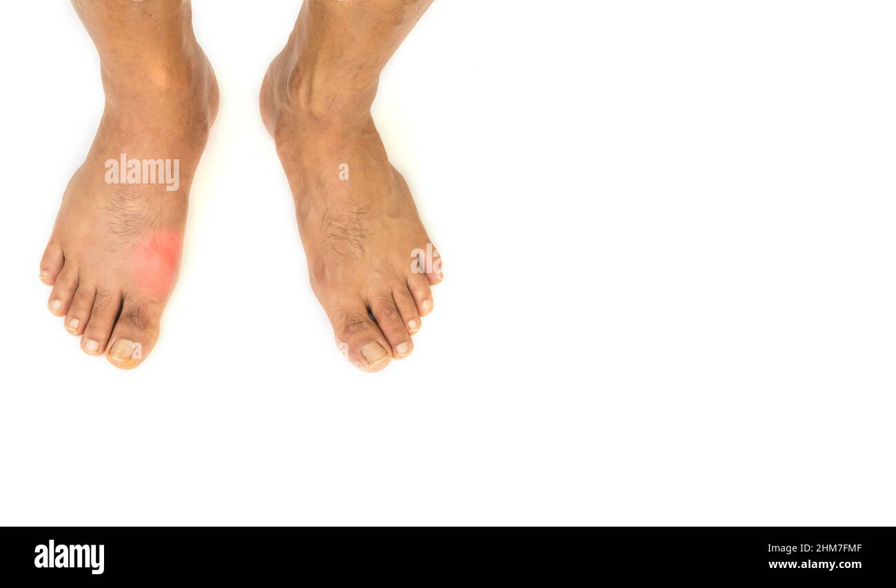 Foot disease Rheumatism and gout. Red leg swelling. Pain in the foot Stock Photo Alamy