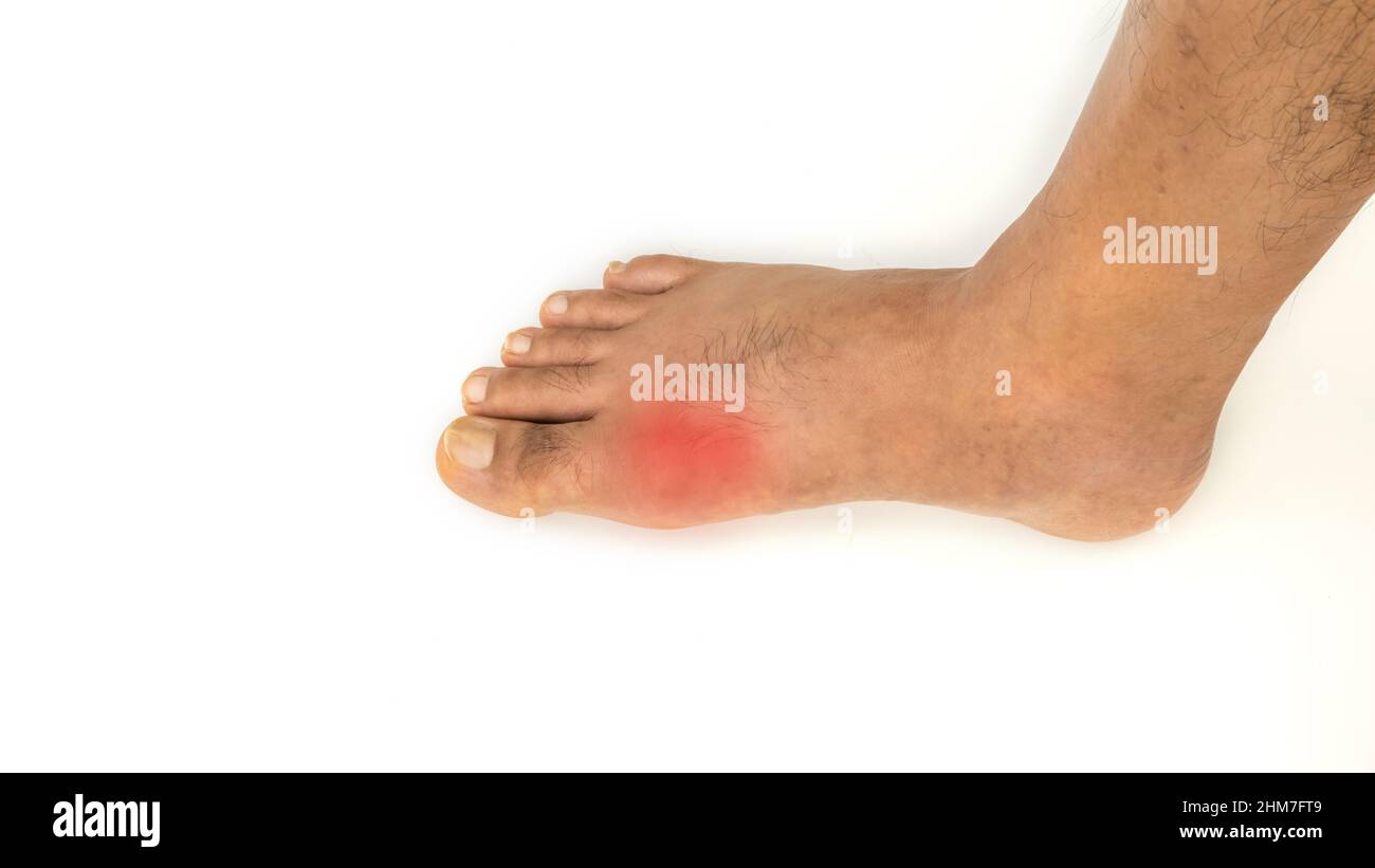 Foot disease Rheumatism and gout. Red leg swelling. Pain in the foot