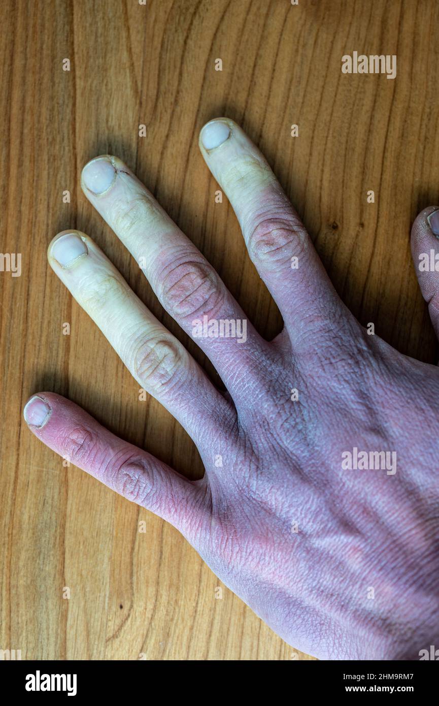 A frostbitten male hand with Raynaud's syndrome, Raynaud's phenomenon or Raynaud's disease. Stock Photo