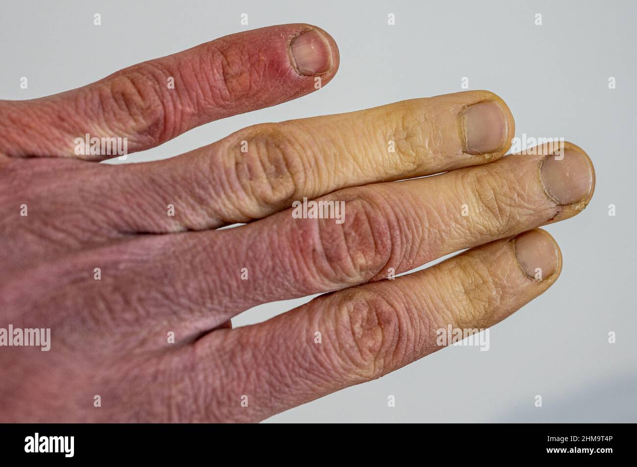 A frostbitten male hand with Raynaud's syndrome, Raynaud's phenomenon or Raynaud's disease. Stock Photo