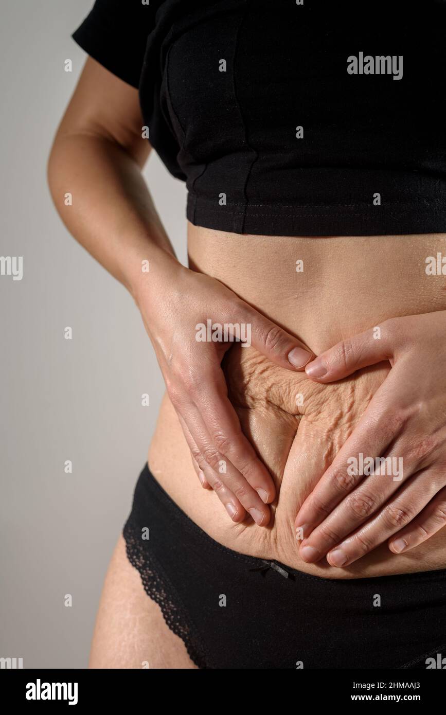 legs and belly of a 40-year-old woman with stretch marks, cellulite and  excess weight on a white isolated background Stock Photo - Alamy