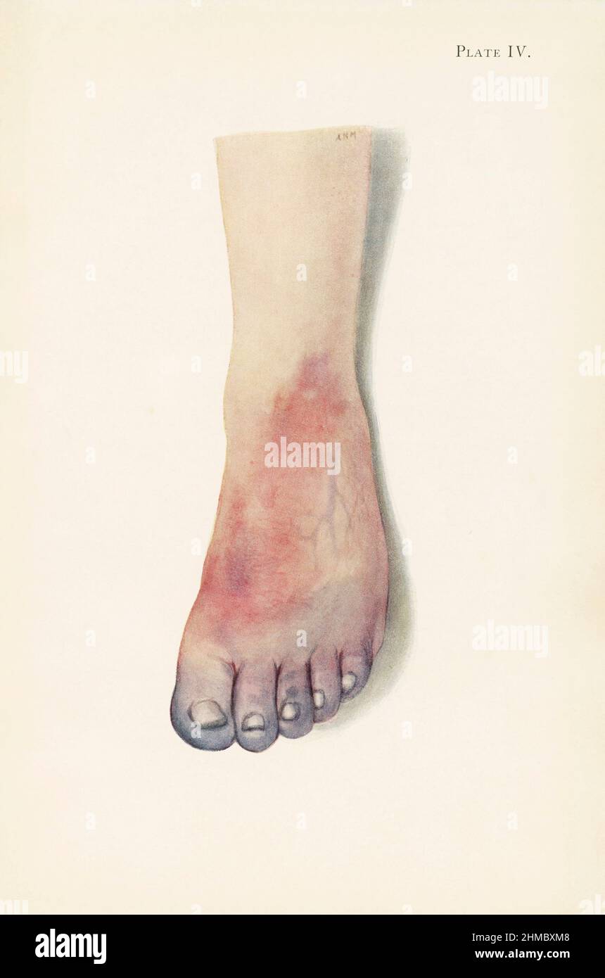 Gangrene of a foot from chlorine poisoning, illustration Stock Photo