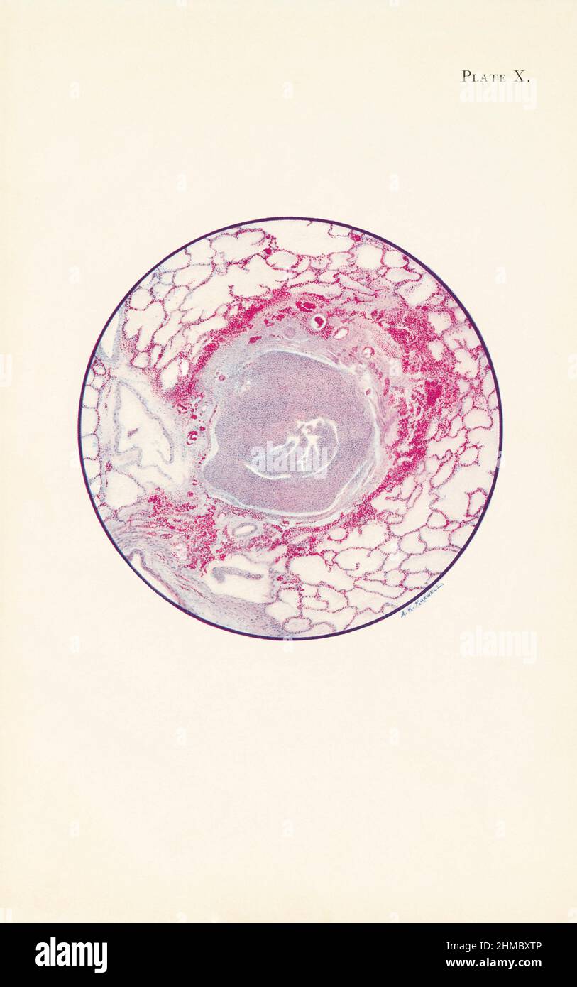 Lung tissue damaged by mustard gas poisoning Stock Photo Alamy