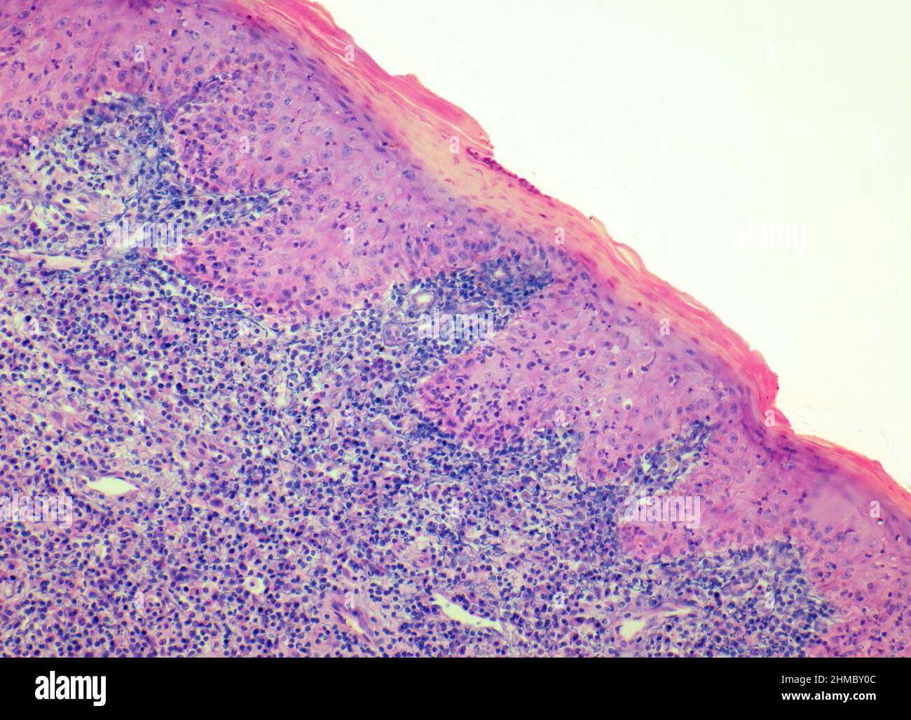 Granulation tissue, LM Stock Photo Alamy