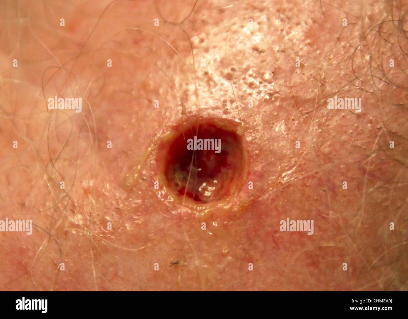 Closeup of a round, raw surgical incision where skin cancer was removed from the top of a man's head during Mohs surgery Stock Photo