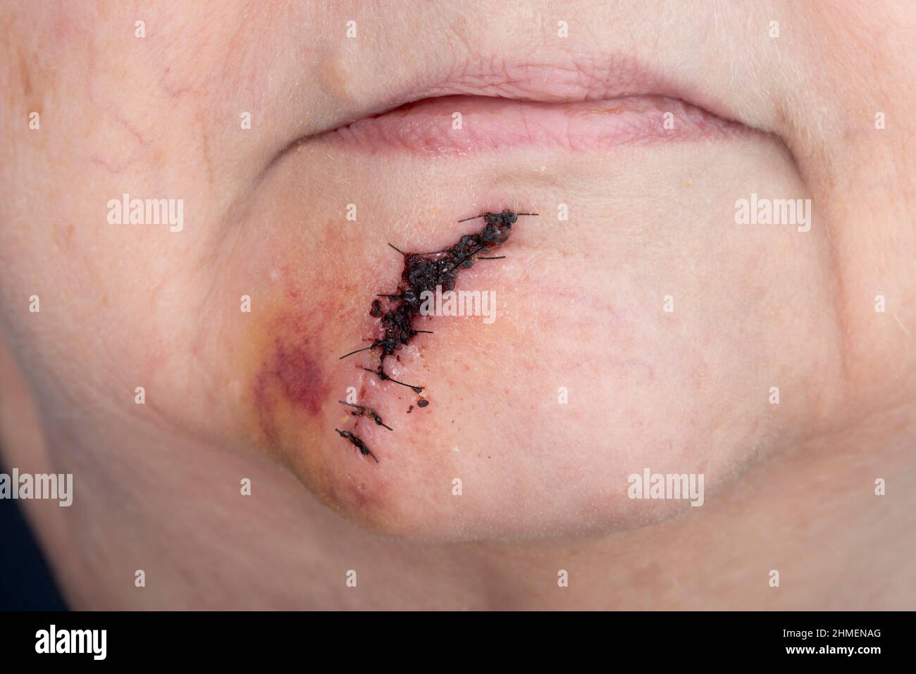 Horizontal shot of a post surgical suture between her lower lip and her chin following skin cancer surgery. Stock Photo