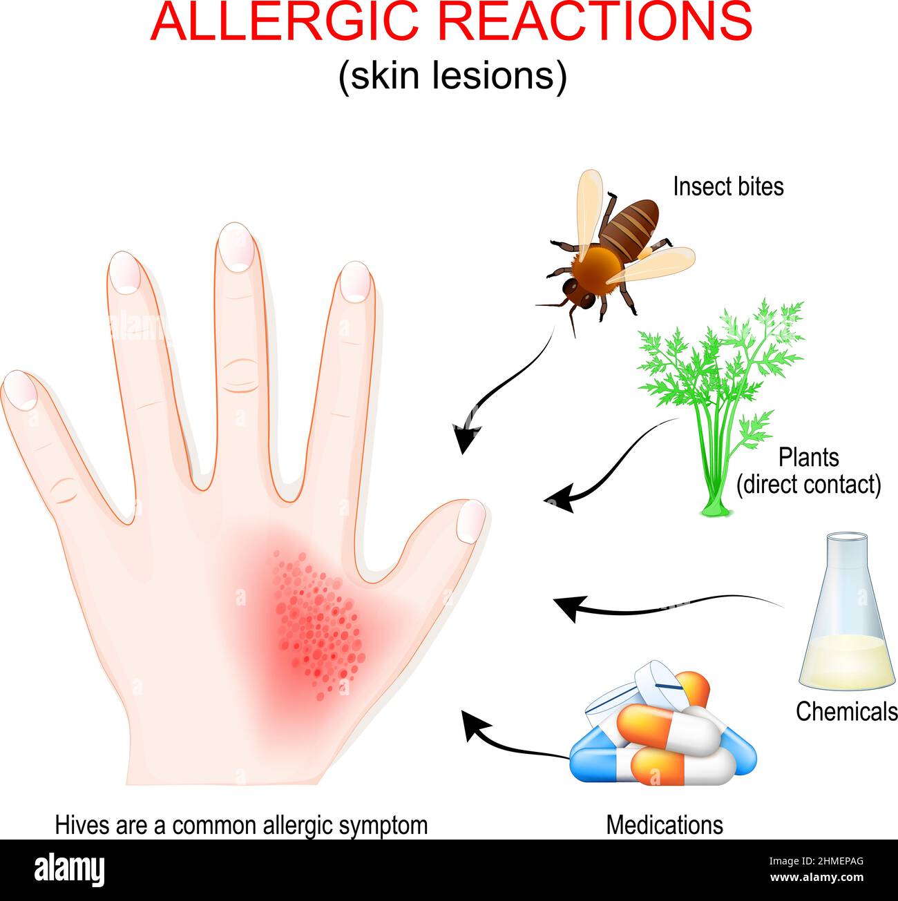 allergic reaction and skin lesions. Human hand with skin rash or urticaria. allergens that caused allergy: medications, chemicals, direct contact Stock Vector