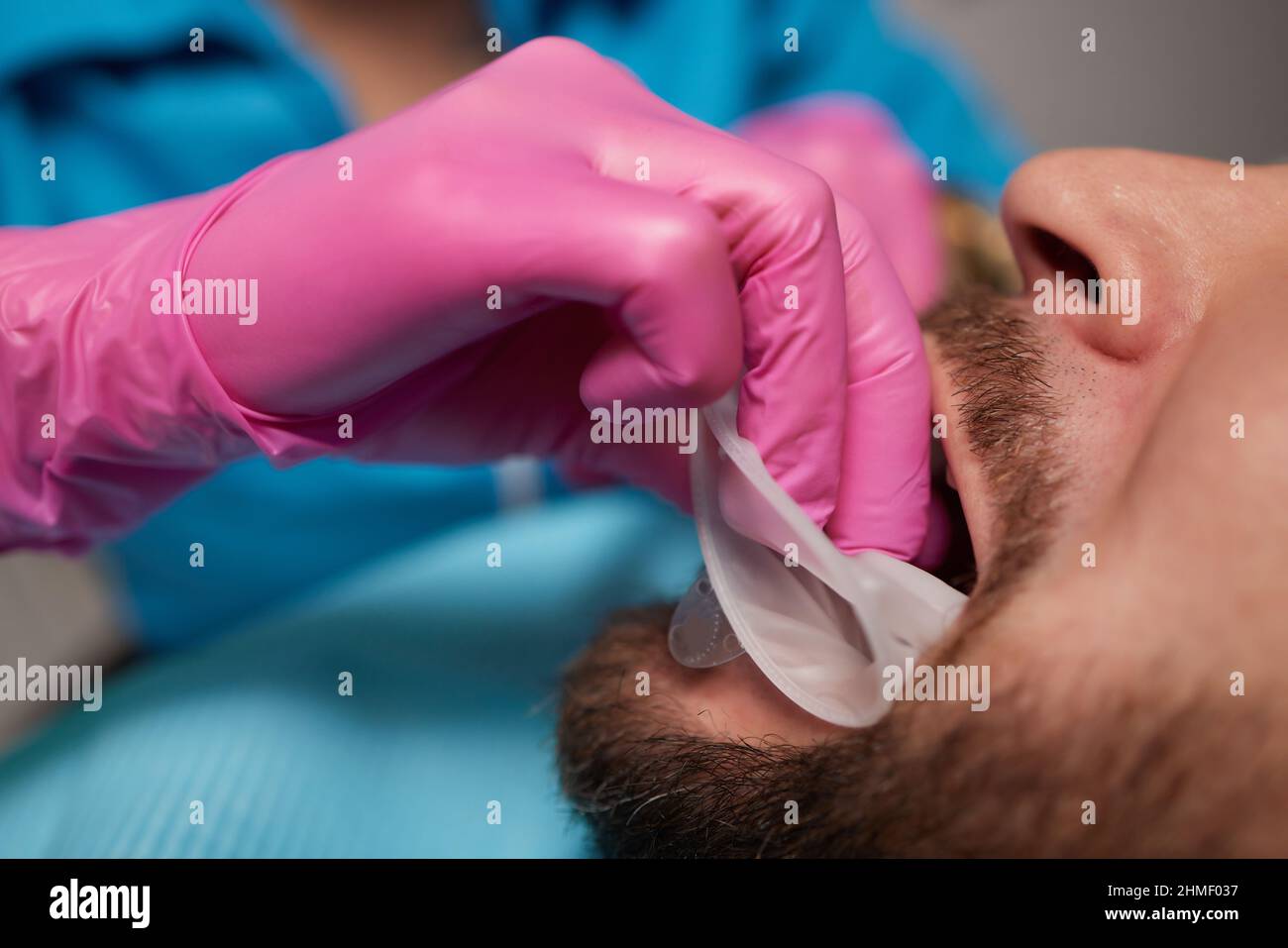 Closeup of man's teeth with retractor for mouth. Patient at the dentist ...