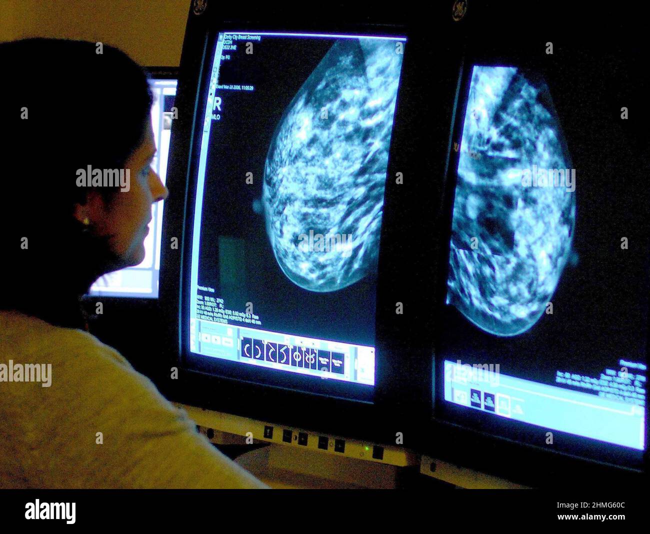 File photo dated 15/06/06 of a consultant analyzing a mammogram. A powerful drug combination for breast cancer could save thousands of lives, according to new results from a long-term study. Issue date: Thursday February 10, 2022. Stock Photo