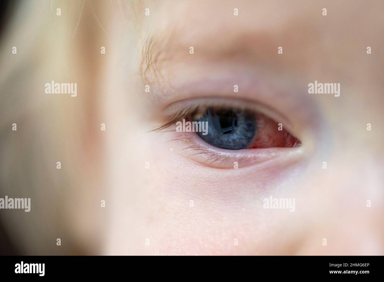 A Close Portrait Of An Infected Red Eye Of A Child With Conjunctivitis The Toddler Or Baby Has Beautiful Blue Eyes Which Have A Red Part In The White Stock Photo A Close Portrait Of An Infected Red Eye Of A Child With Conjunctivitis The Toddler Or Baby Has Beautiful Blue Eyes Which Have A Red Part In The White Stock Photo