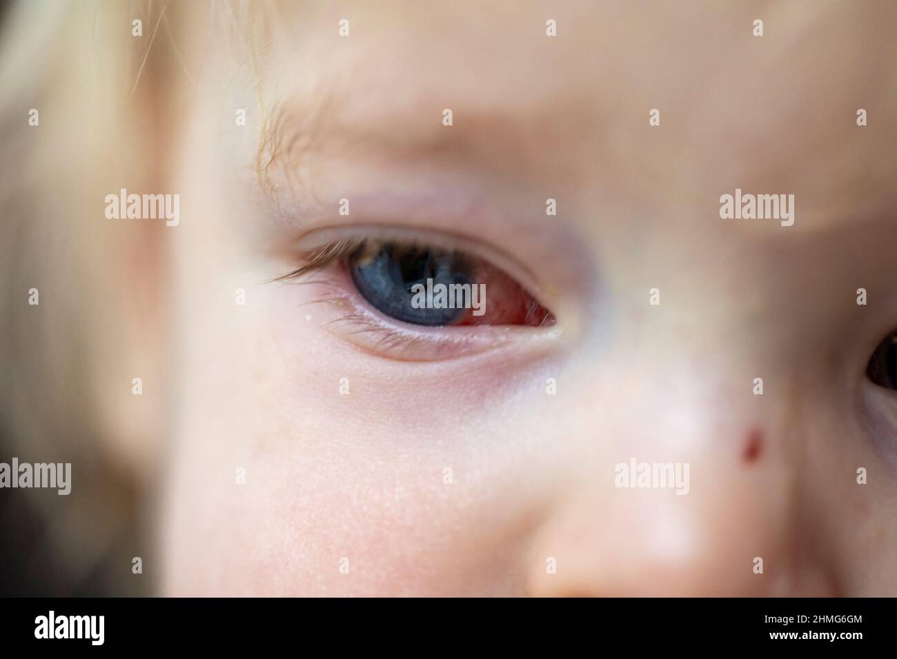 A portrait of an infected red eye of a child with conjunctivitis. The