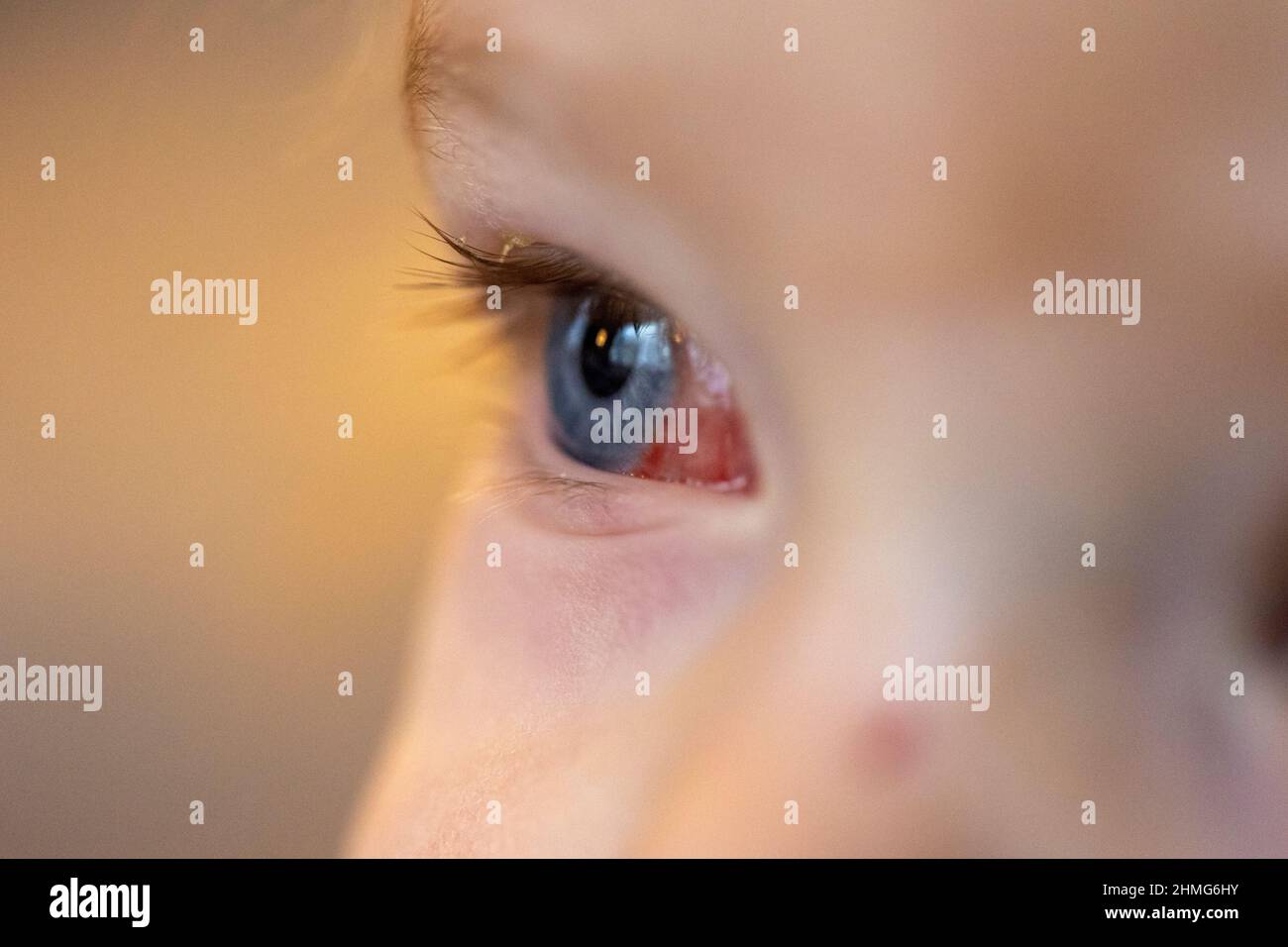 A Portrait Of An Infected Red Eye Of A Child With Conjunctivitis The Toddler Or Baby