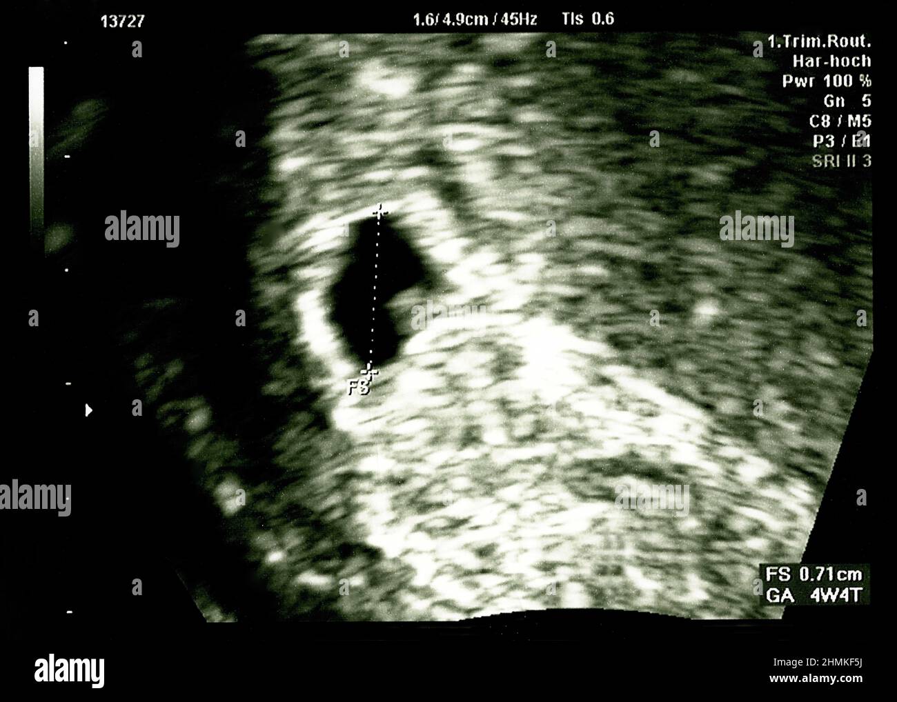 fetal development baby 4 weeks pregnant ultrasound