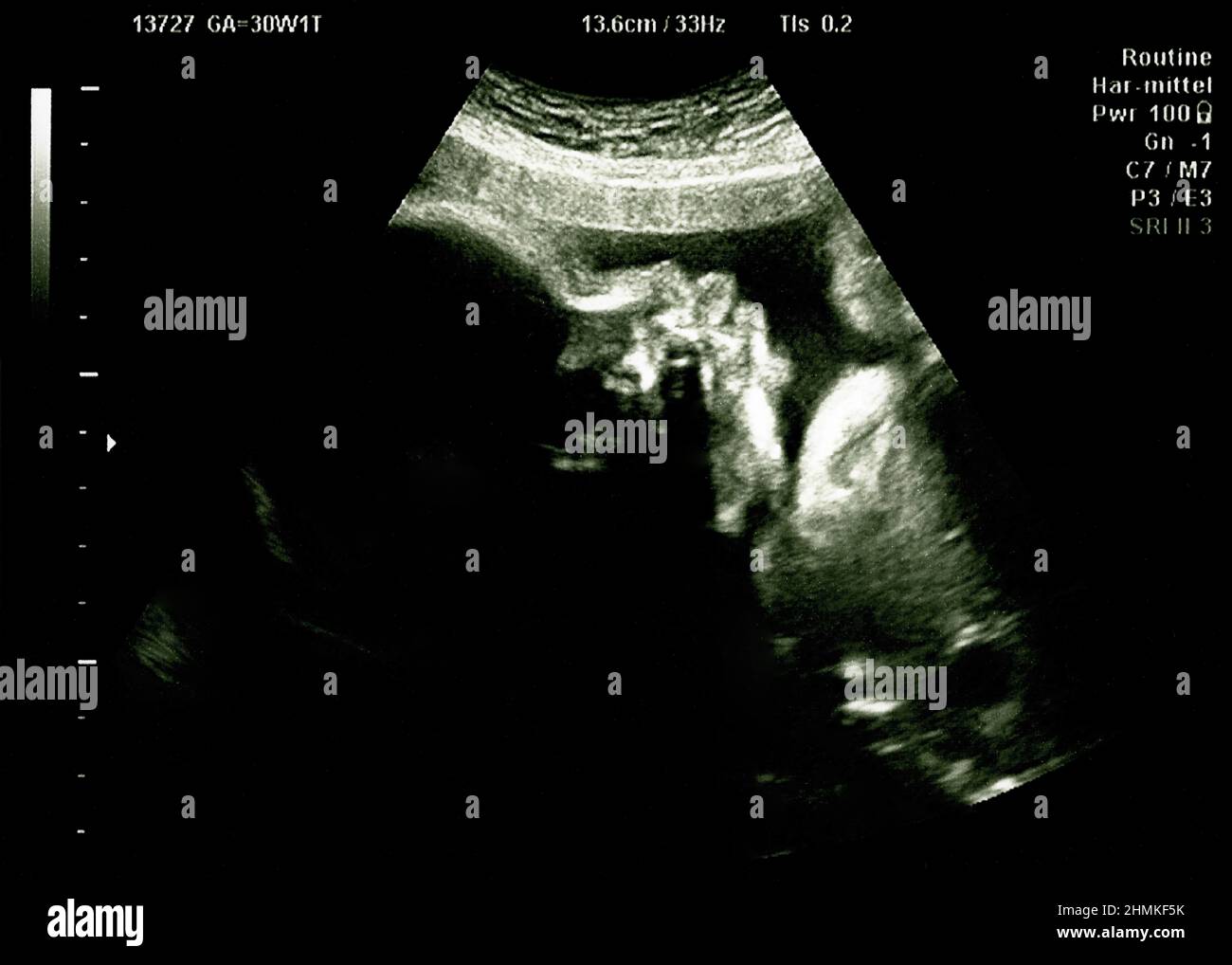 Baby head on ultrasound scan in hospital check, Echography Scan Stock Photo Alamy