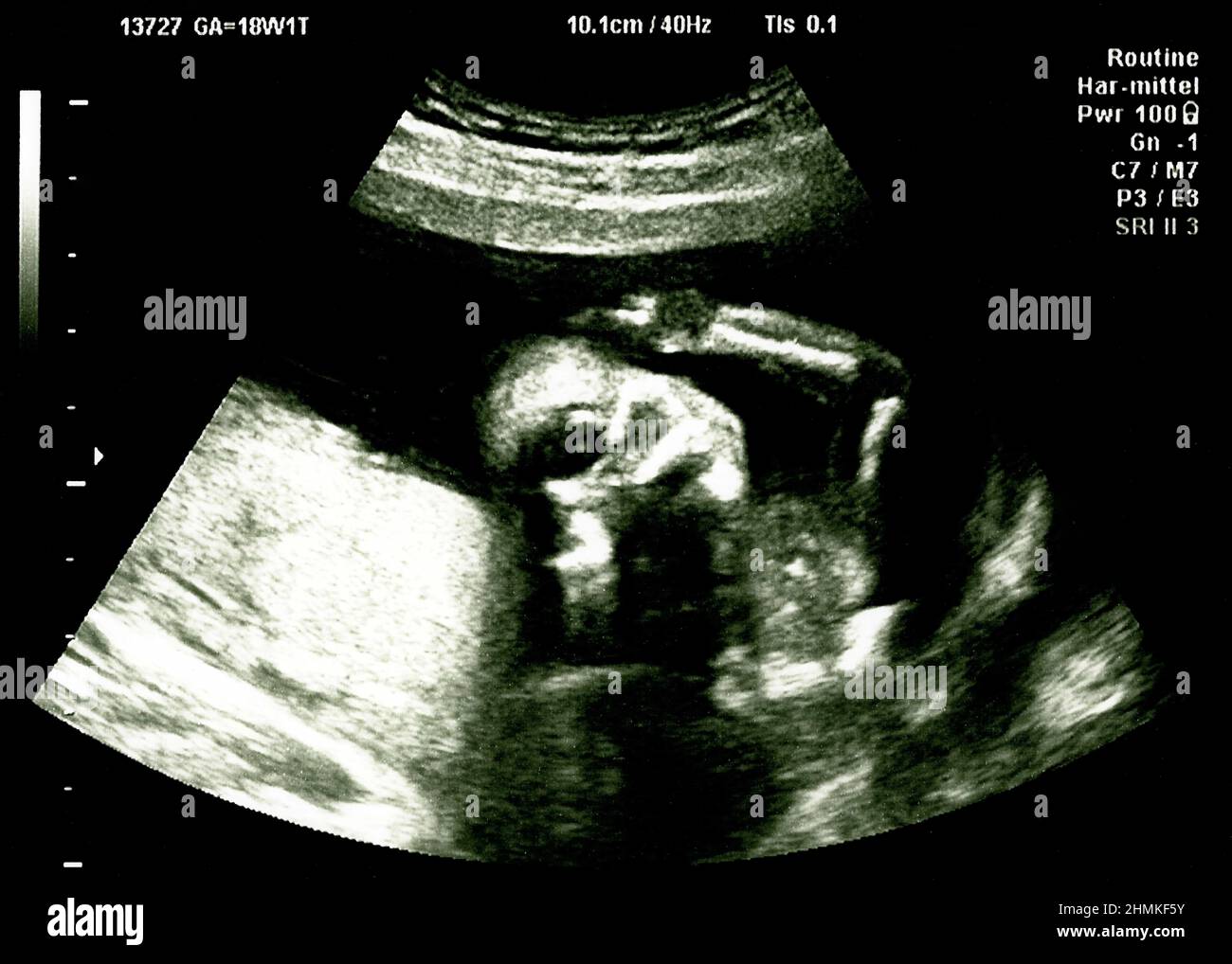 Baby Head On Ultrasound Scan In Hospital Check Stock Photo Alamy