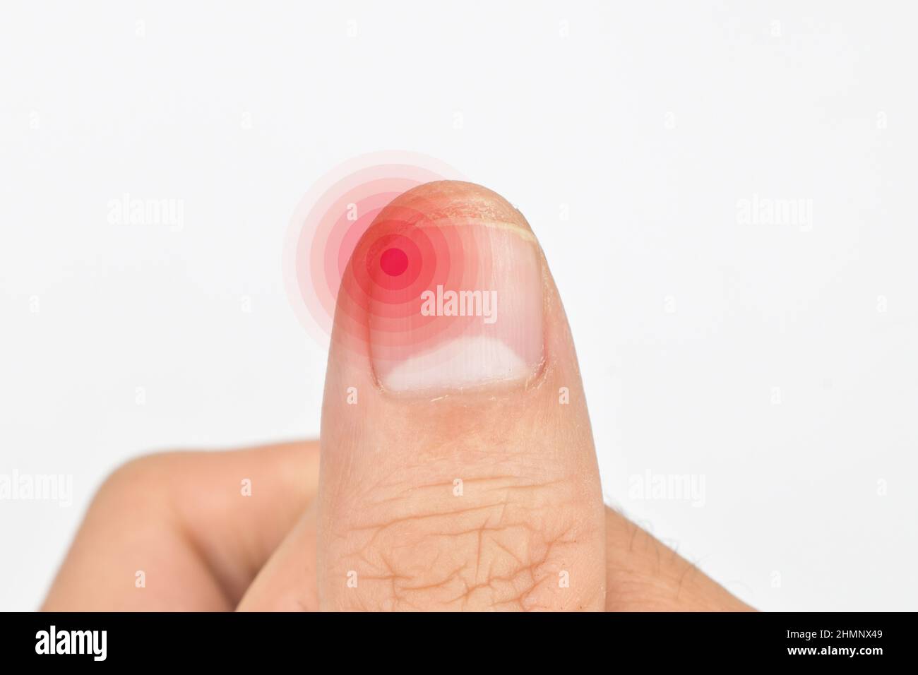 Inflammation at the tip of fingernail. Concept of paronychia at thumb