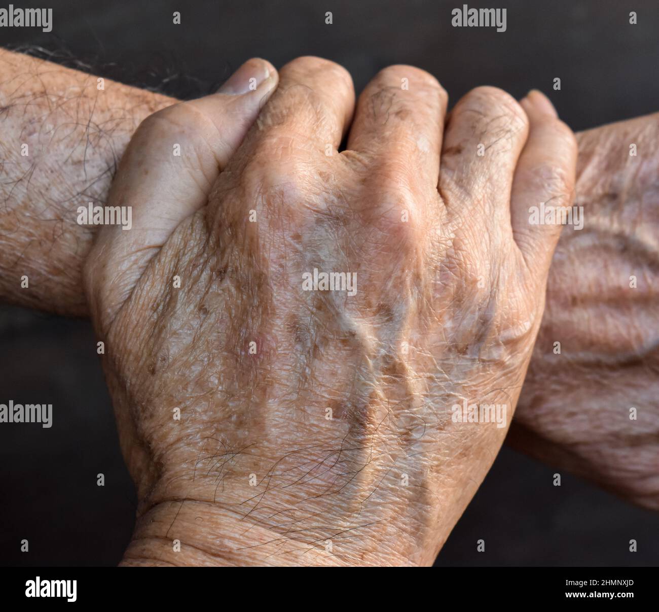 Age Spots Hands Hi Res Stock Photography And Images Alamy