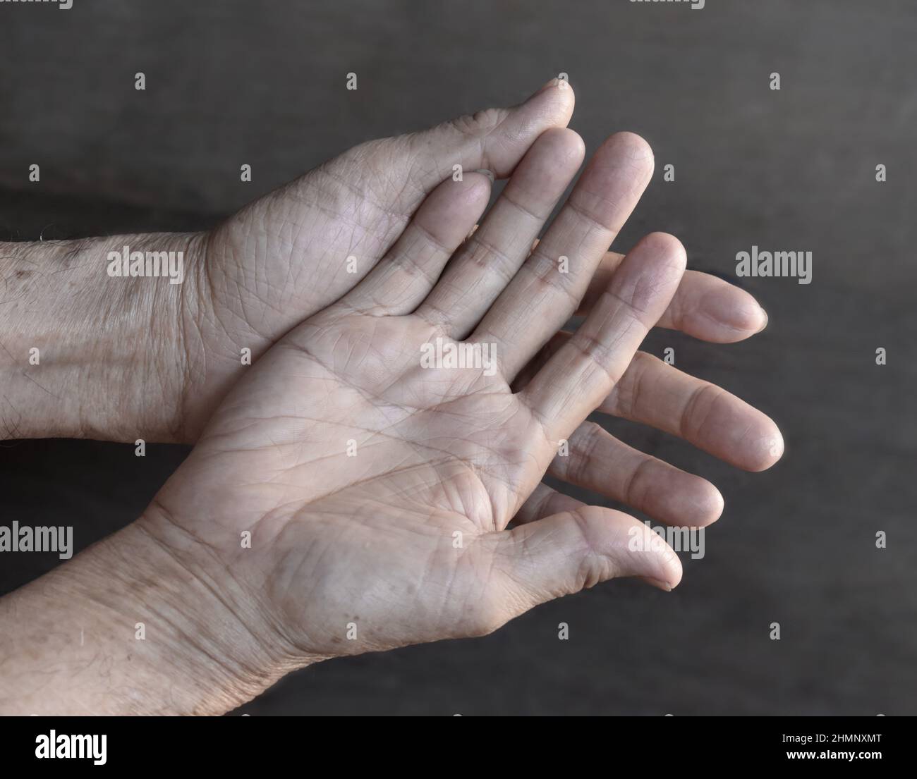 Pale palmar surface of both hands. Anaemic hands of Asian, Chinese old