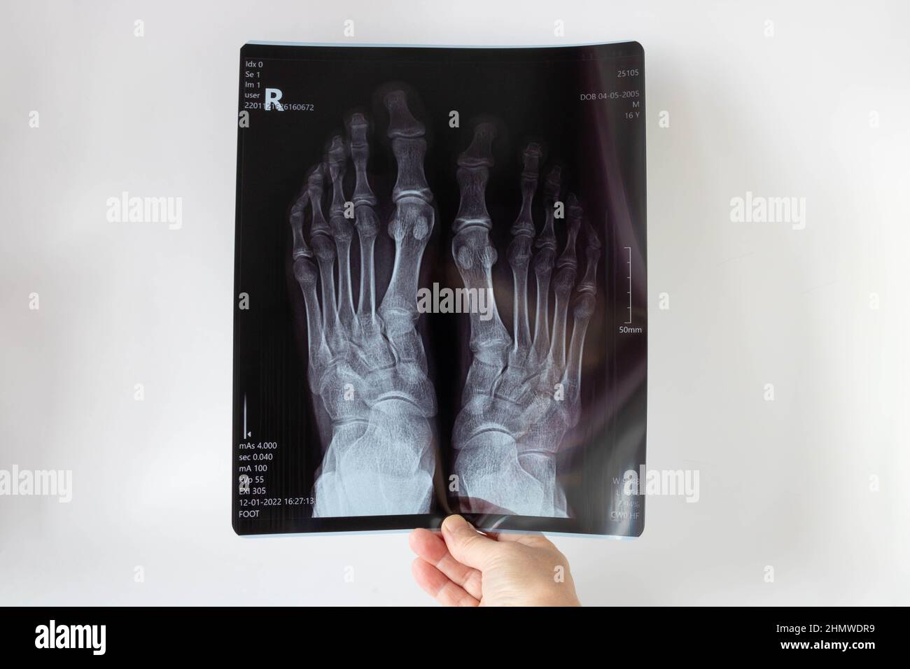 Radiography of the foot in the anterior projection. Medical Xray of the teenager's legs.The