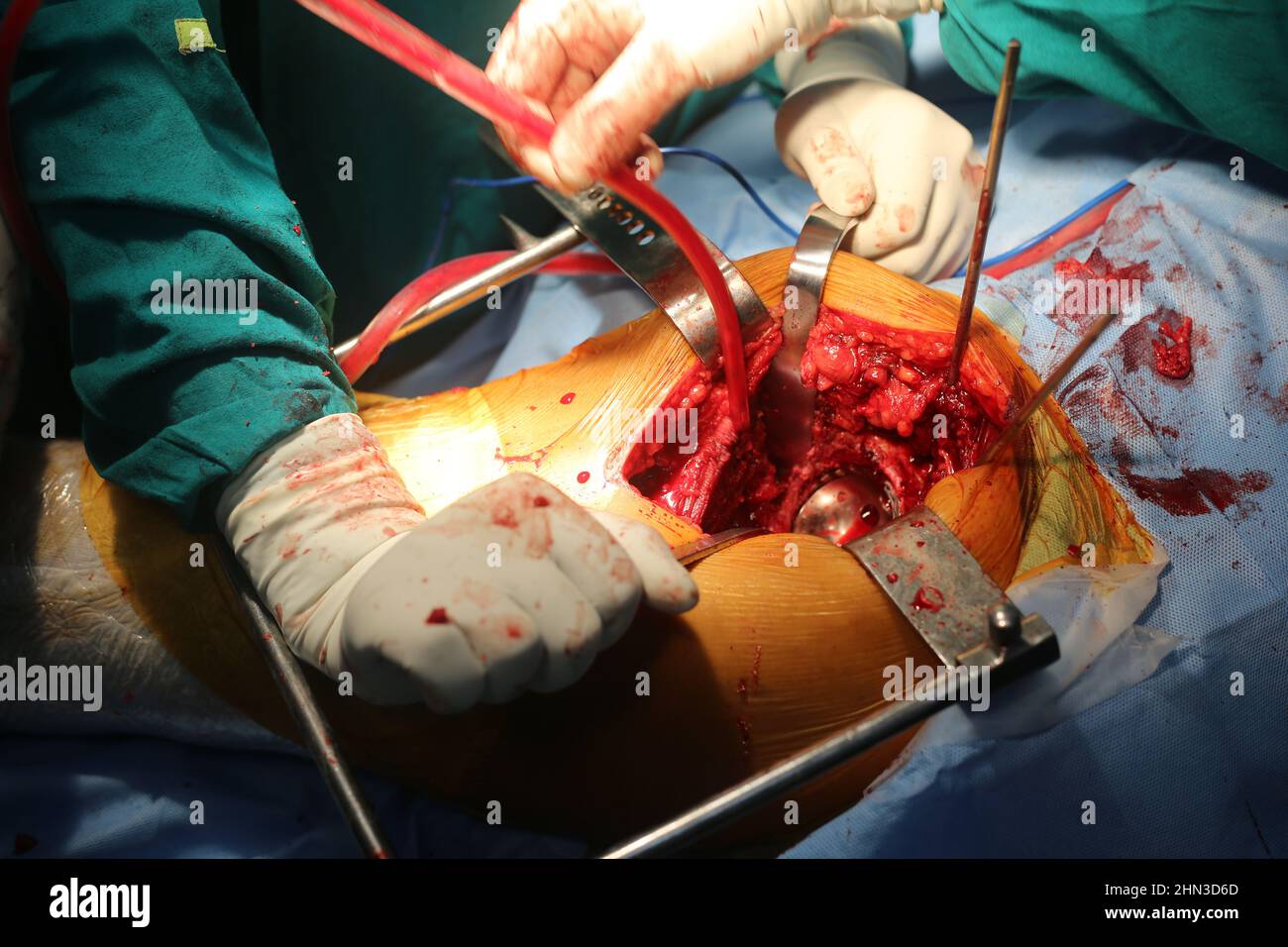 Knee replacement surgery in Operation theatre Stock Photo