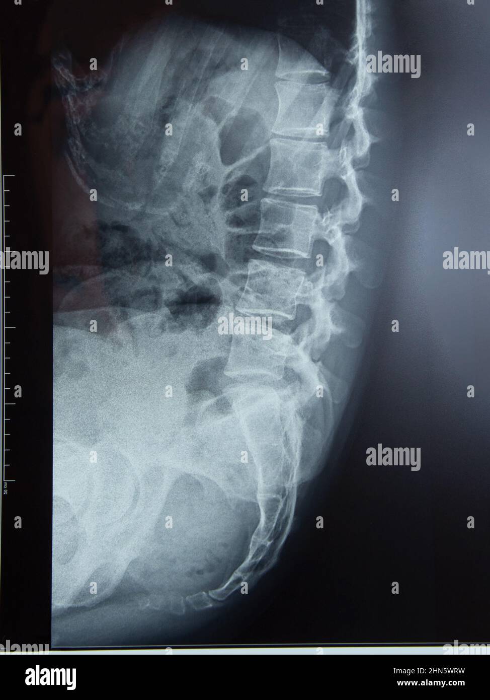 Medical x-ray of the spine body isolated on the white background Stock Photo