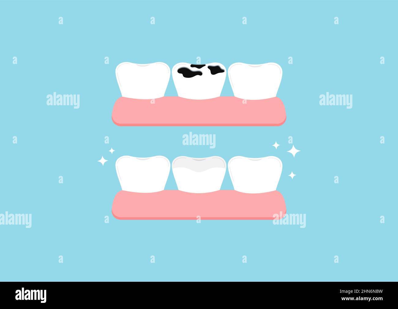 Teeth before and after multiple caries in gym dental icon set isolated ...