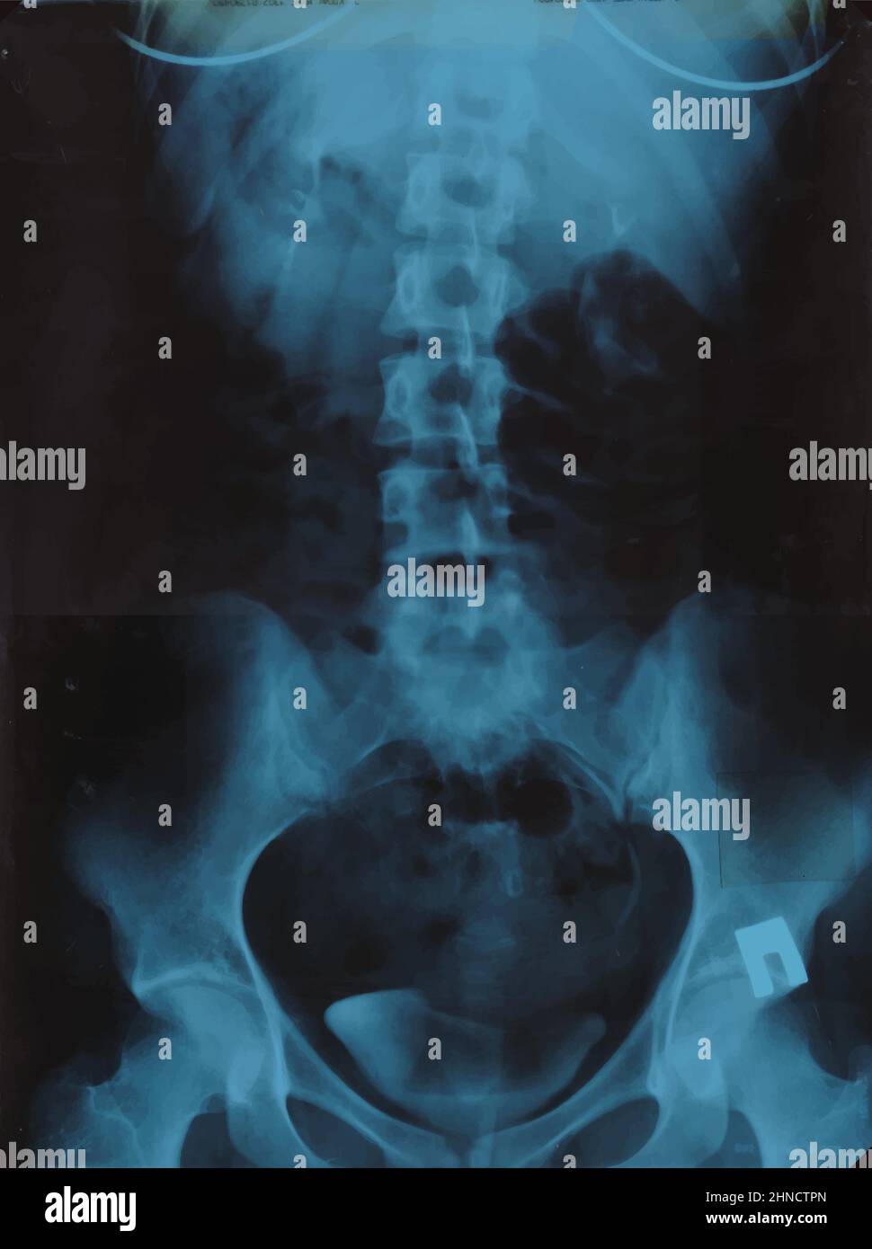Realistic Lumbar spine x ray, pelvic bones MRI scan picture. Vector illustration Stock Vector