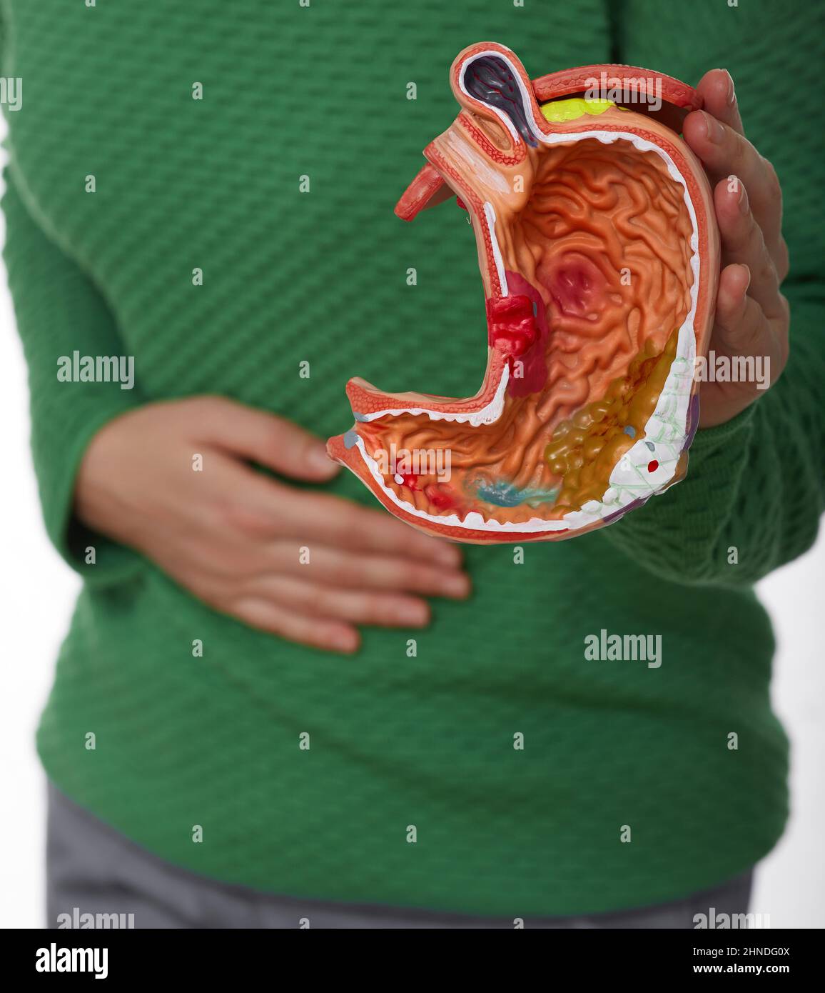 Woman with pain in stomach area holding anatomical model of stomach with pathology. medical treatment of stomach disease, ulcer and gastritis Stock Photo