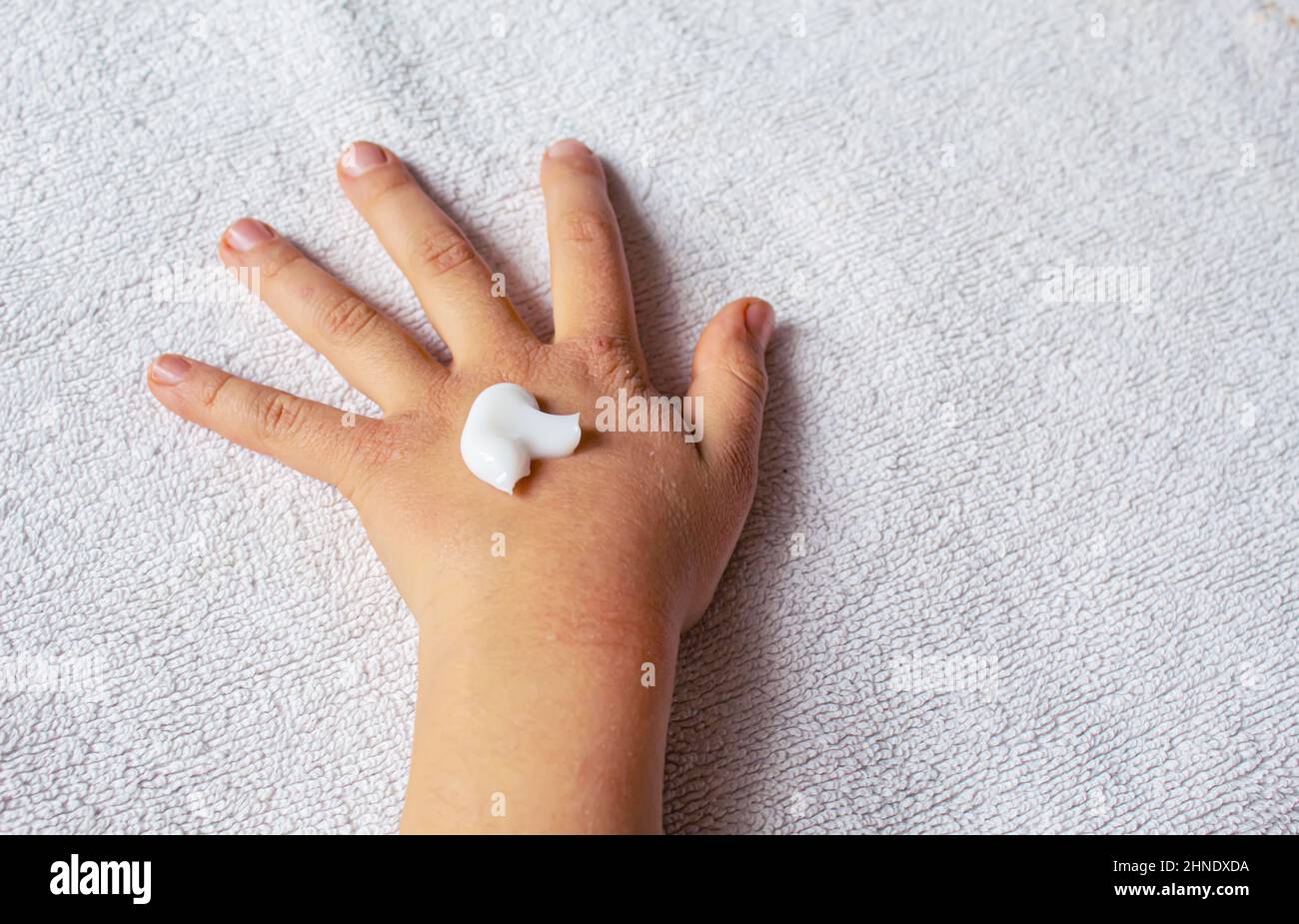 Red spots on the skin of the child's hands.children's allergy.selective focus Stock Photo