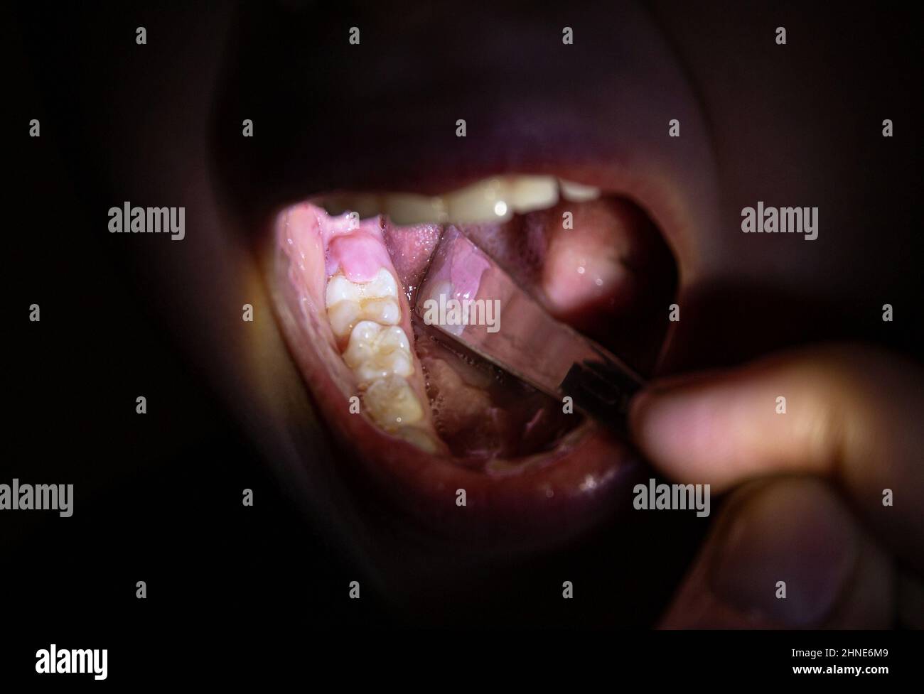 6 year old child with gum flap over child molar. Medical problem, Pericoronitis. 6 year old girl molar eruption. Stock Photo