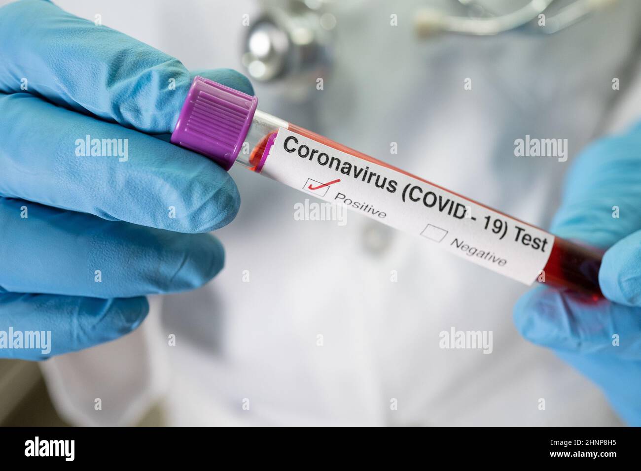 Positive blood infection sample in test tube for covid19 coronavirus