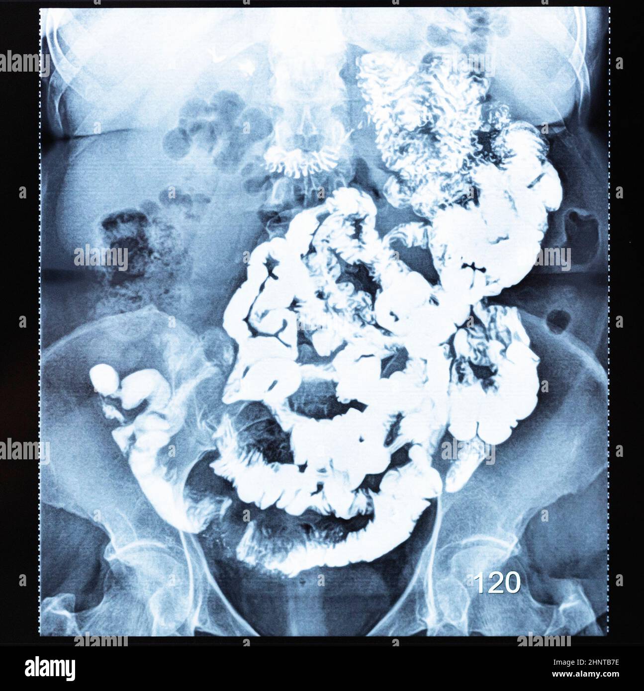 Barium study of small bowel after two hours Stock Photo