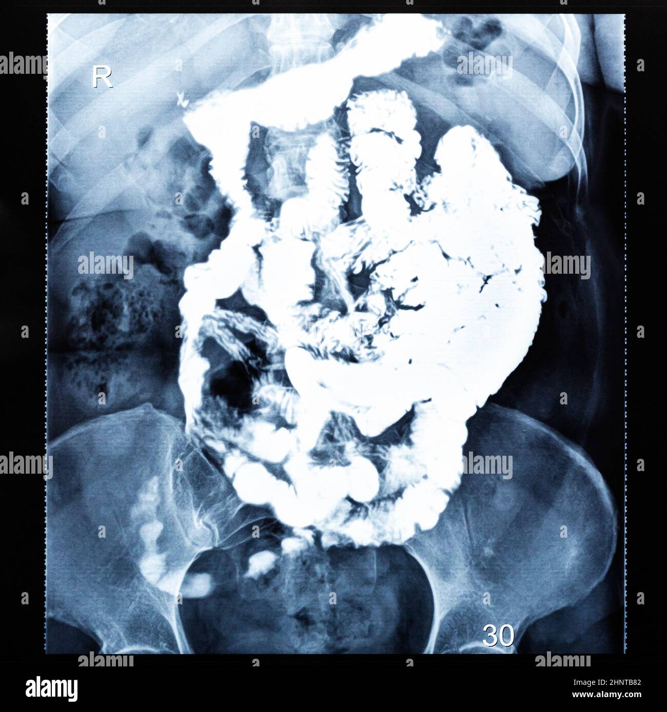 Barium study of small bowel after thirty minutes Stock Photo