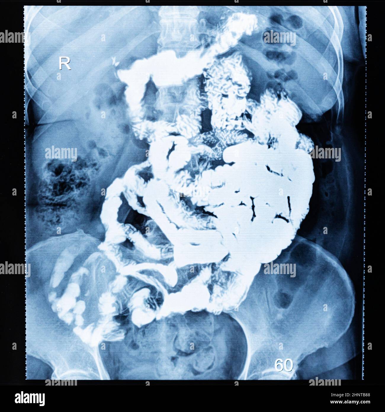 Barium study of small bowel after sixty minutes Stock Photo