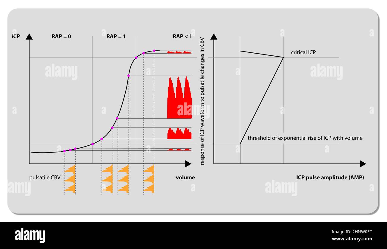 Intracranial Pressure Monitoring ICP waveform, 3d render, 2d graphic, illustration Stock Photo
