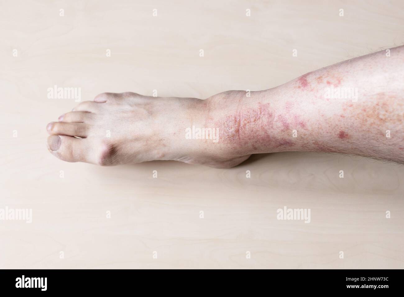 Sample Of Allergic Contact Dermatitis Male Shin With Itchy Red Rash