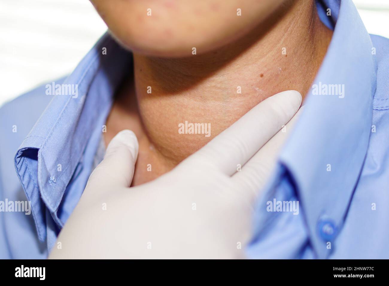 Asian lady woman patient have abnormal enlargement of thyroid gland Hyperthyroidism (overactive thyroid) at the throat, healthy strong medical concept Stock Photo