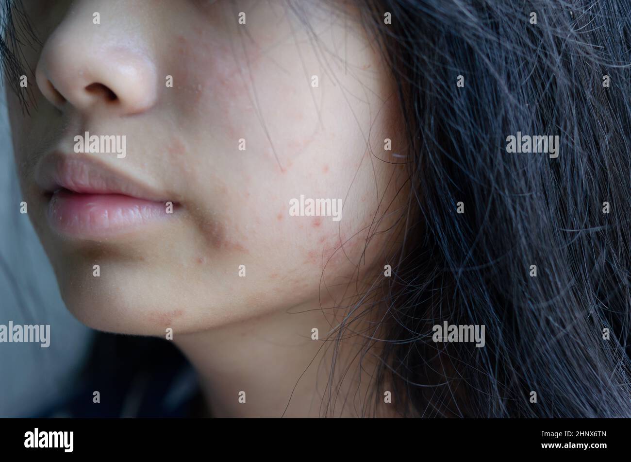 rash face woman allergic to cosmetics food allergy or air allergy Stock