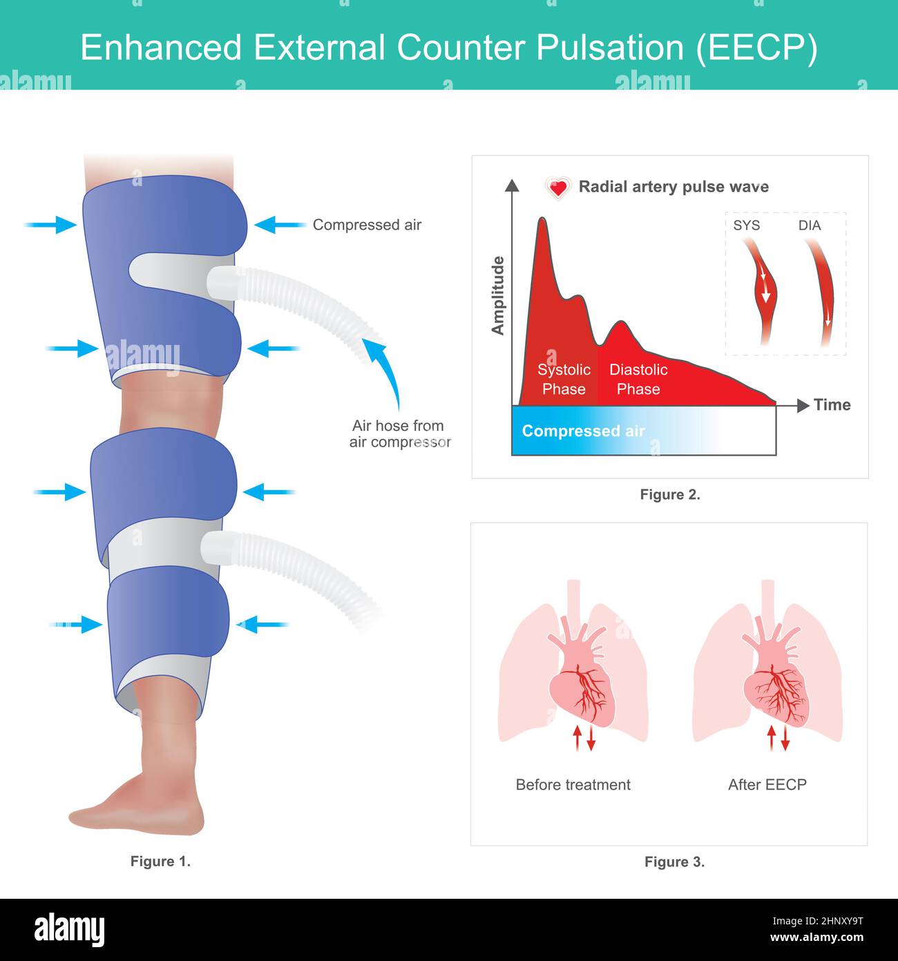 Enhanced External Counter Pulsation. A method of improving blood flow to the heart by use strip constrict around on legs. Stock Vector