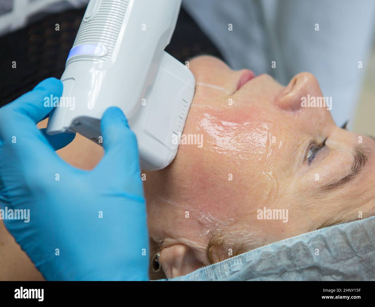 Nonsurgical face lifting. SMAS lifting ultrasonic. The process of
