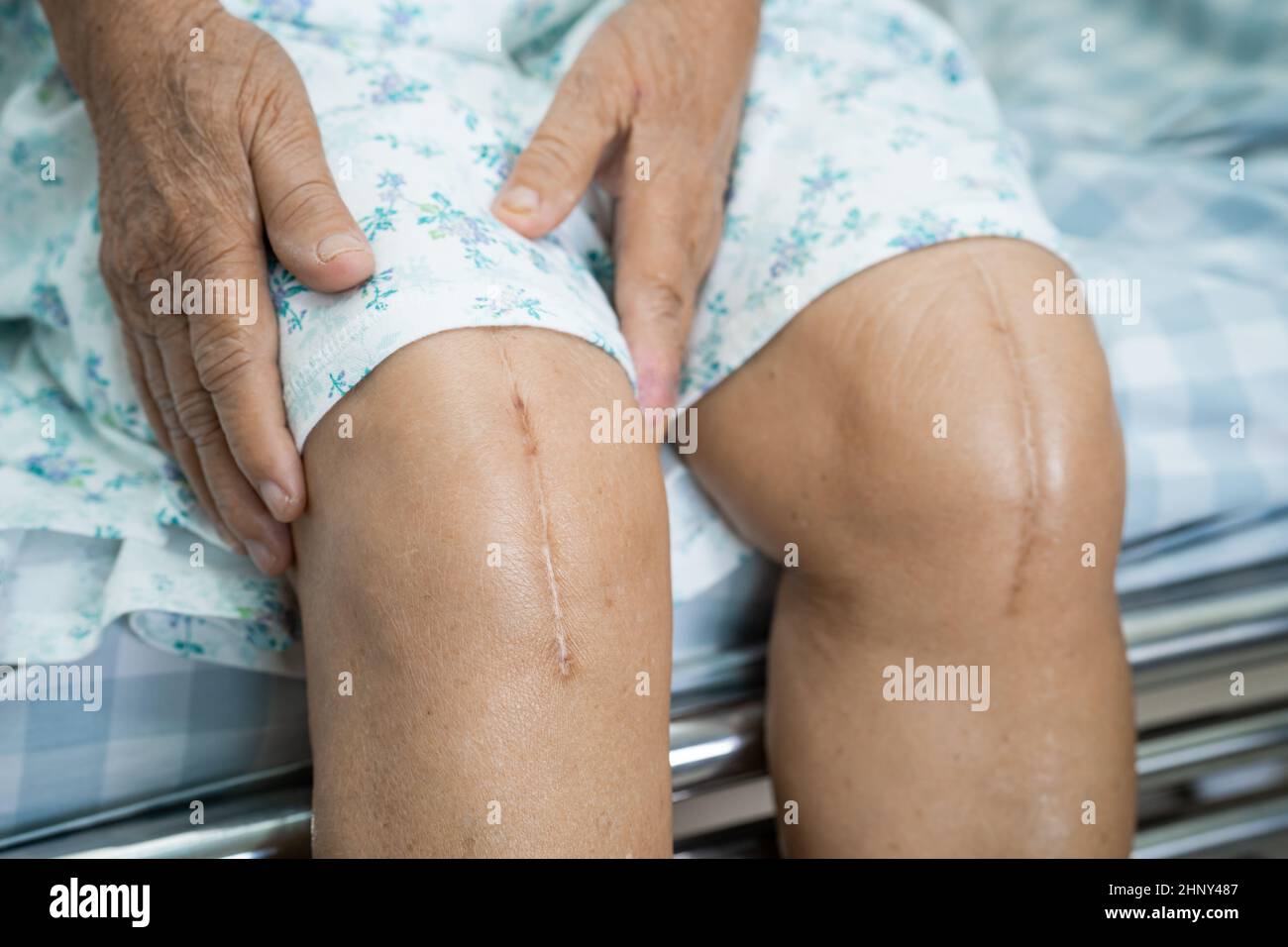 Asian senior or elderly old lady woman patient show her scars surgical total knee joint replacement Suture wound surgery arthroplasty on bed in nursin Stock Photo