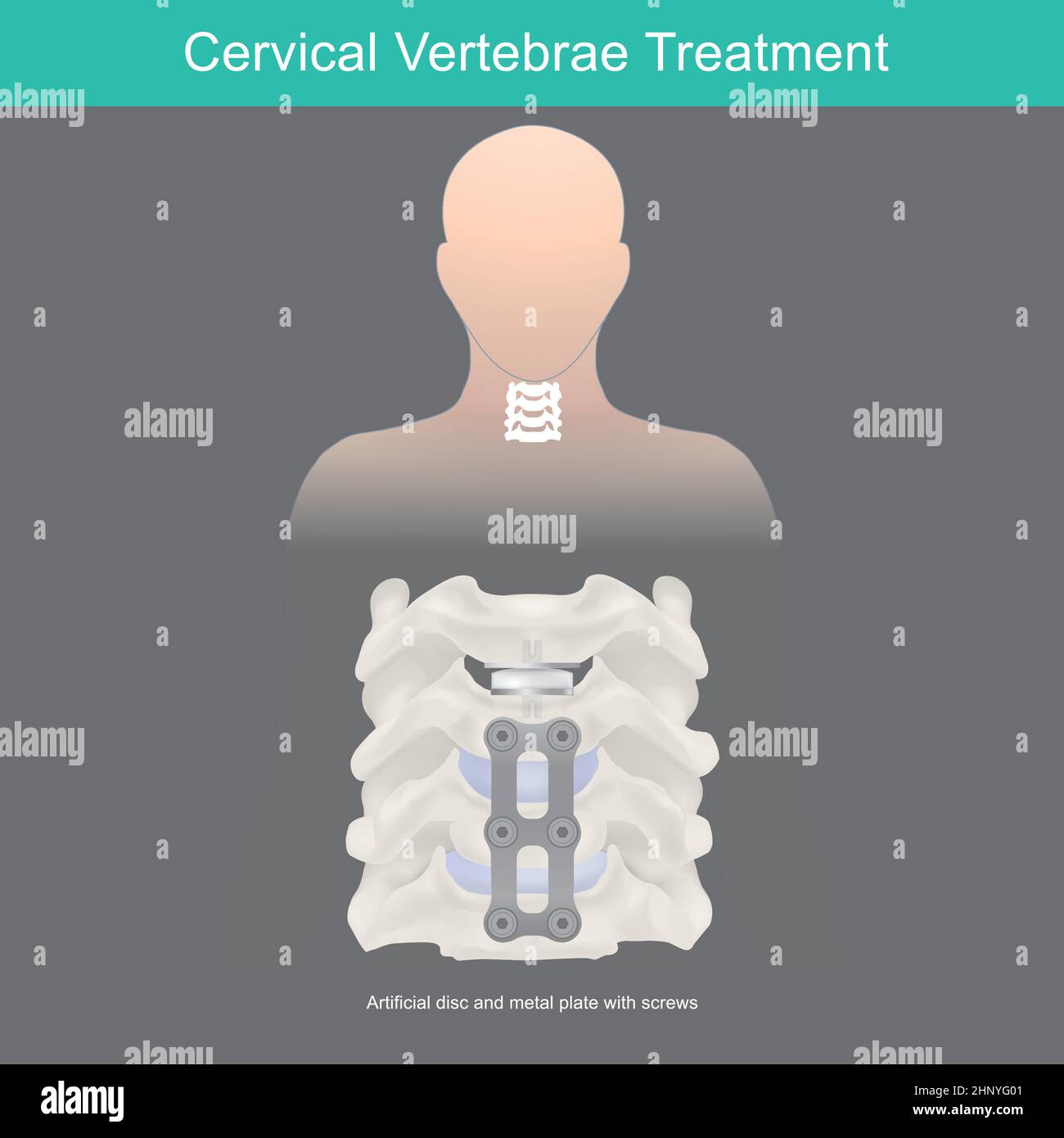 Cervical Vertebrae Treatment. Neck bone anatomy and artificial disc replacement. Stock Vector