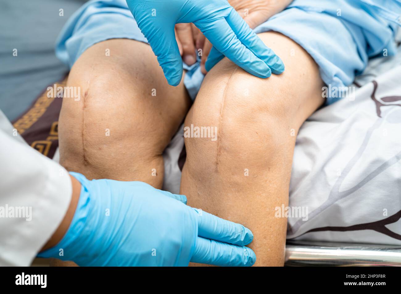 Asian senior or elderly old lady woman patient show her scars surgical total knee joint replacement Suture wound surgery arthroplasty on bed in nursin Stock Photo