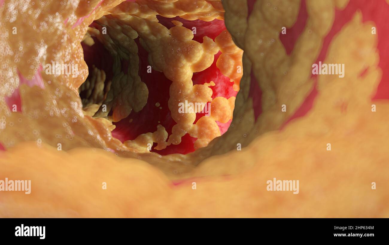 Fatty human artery, illustration. Stock Photo